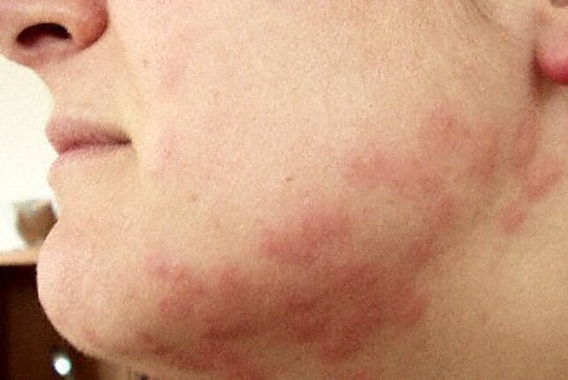 Réactions Allergiques aux Piqûres de Punaises de Lit : Symptômes et Soins